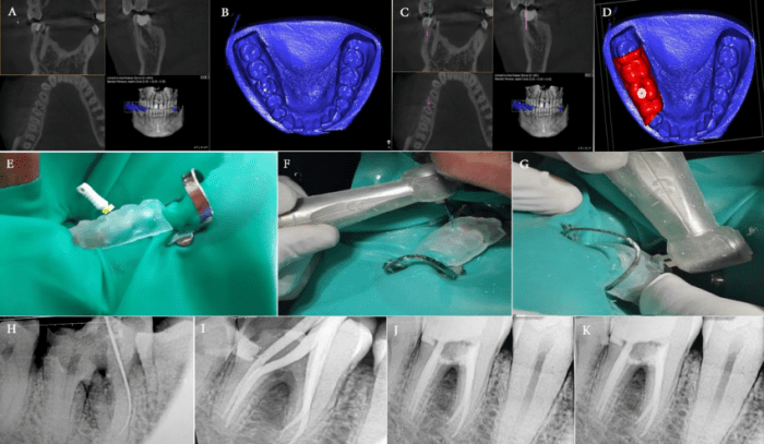 Surgical separation of a multirooted tooth through the furcation area