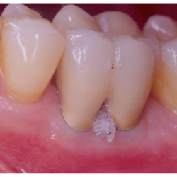 Surgical separation of a multirooted tooth through the furcation area