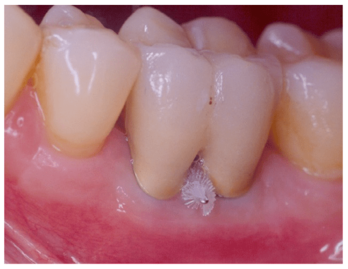 Surgical separation of a multirooted tooth through the furcation area