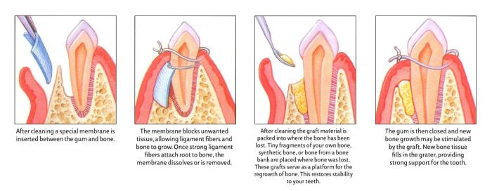 Probing periodontal furcation